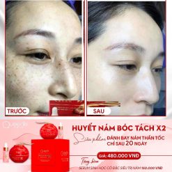 Kem Face Giảm Nám Queenie Skin Huyết Nám Bóc Tách X2 Melasma Cream - 8936136420035