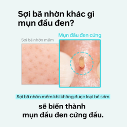 Tinh Chất Ủ Mụn Đầu Đen ILSO Super Melting Sebum Softener 150g Giúp Sạch Bã Nhờn Sáng Da - 8809635332010