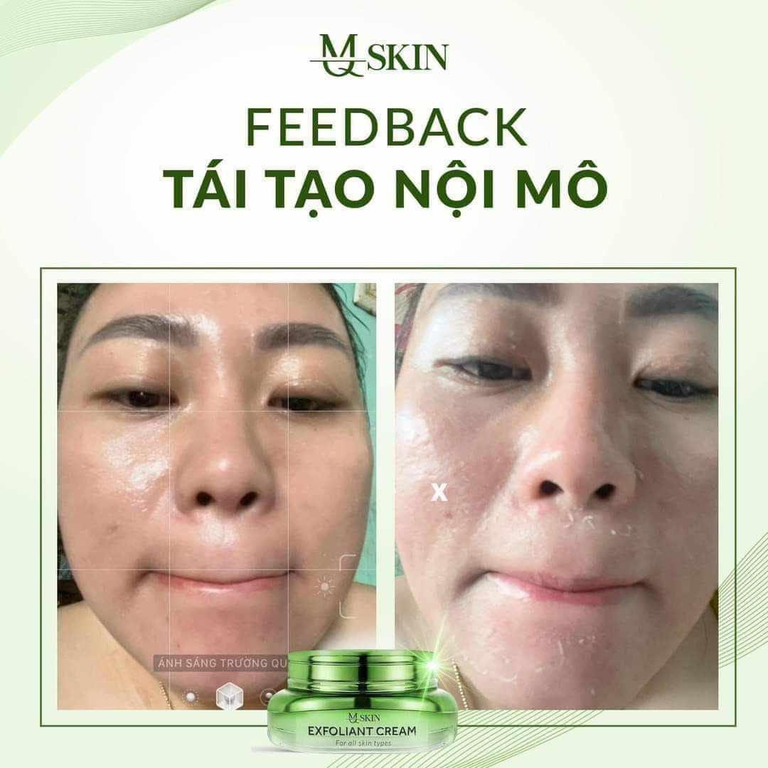 Kem Face Tái Tạo Nội Sinh Exfoliant Cream MQ Skin Kem Face Tái Tạo Nội Sinh Exfoliant Cream MQ Skin