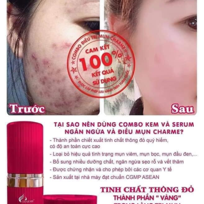 Kem Face Mụn Hàn Quốc Charme Anti Acne Whitening Cream Kem Face Mụn Hàn Quốc Charme Anti Acne Whitening Cream