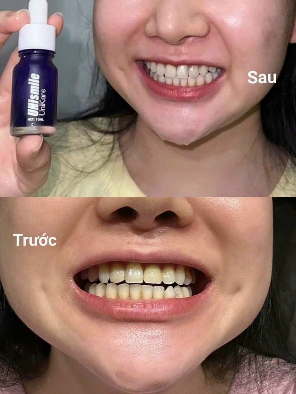 Serum Trắng Răng Unismile, Hỗ Trợ Cải Thiện Vết Ố Vàng Unikare Serum Trắng Răng Unismile, Hỗ Trợ Cải Thiện Vết Ố Vàng Unikare