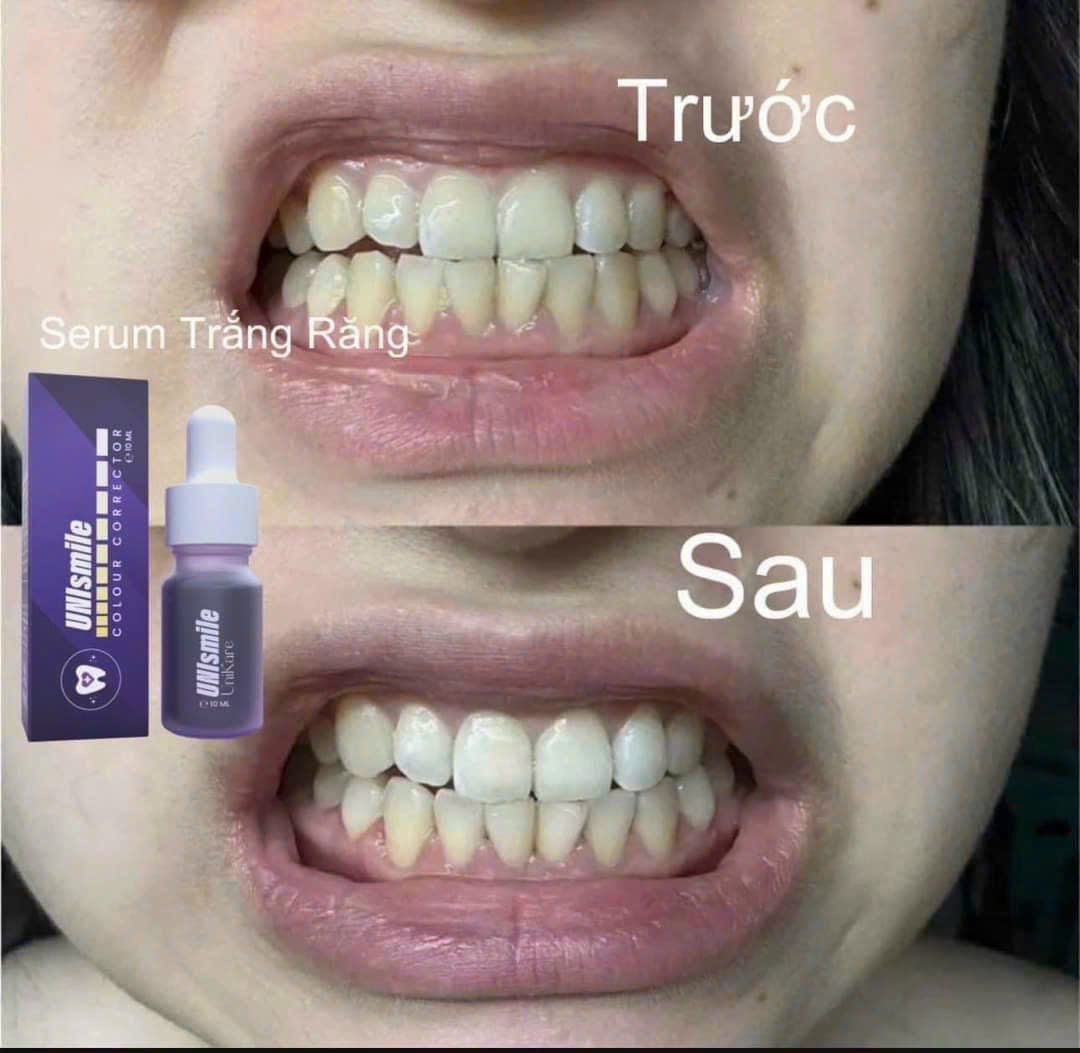 Serum Trắng Răng Unismile, Hỗ Trợ Cải Thiện Vết Ố Vàng Unikare Serum Trắng Răng Unismile, Hỗ Trợ Cải Thiện Vết Ố Vàng Unikare