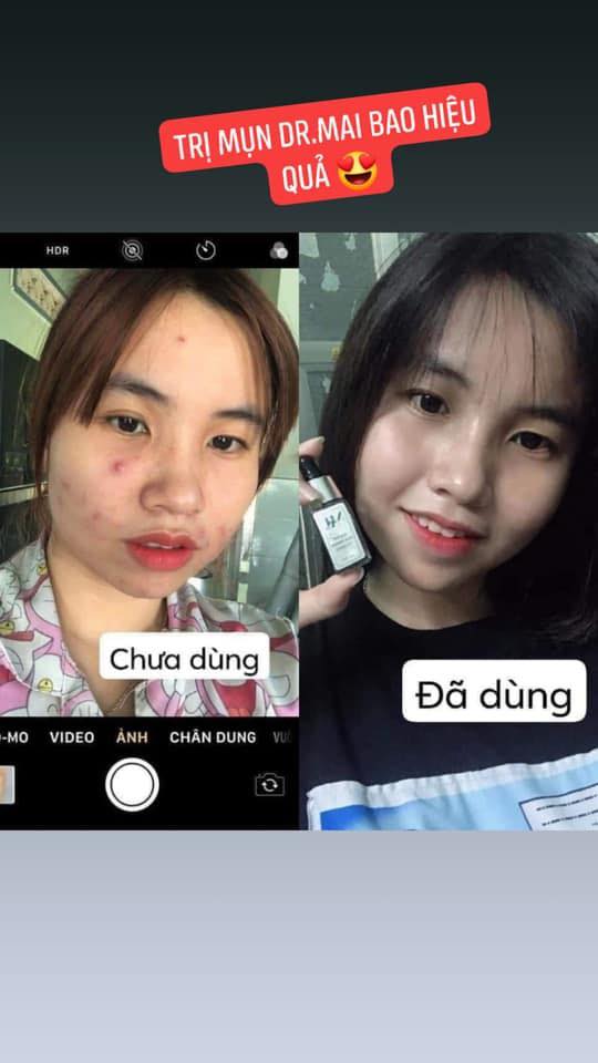 Đừng để mụn nặng rồi mới loay hoay tìm cách chữa trị nha mọi ngườiiiii