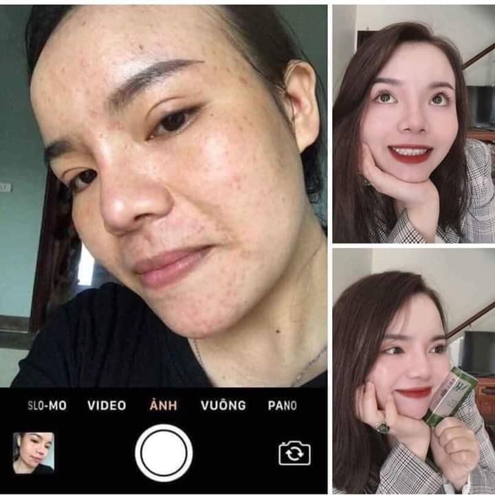 Có ai sau 25 tuổi vẫn còn bị mụn không?