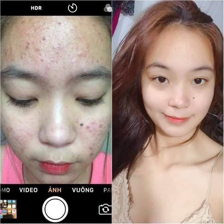 Đừng để mụn cản trở cuộc sống của bạn!