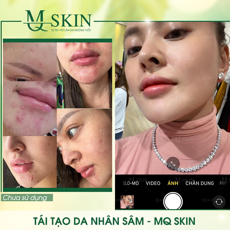 Vì sao "BB Cream tái tạo da MQ Skin" gây siêu bão trên thị trường? Vì sao "BB Cream tái tạo da MQ Skin" gây siêu bão trên thị trường?