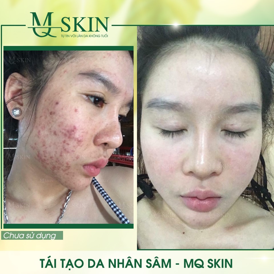 Vì sao "BB Cream tái tạo da MQ Skin" gây siêu bão trên thị trường? Vì sao "BB Cream tái tạo da MQ Skin" gây siêu bão trên thị trường?