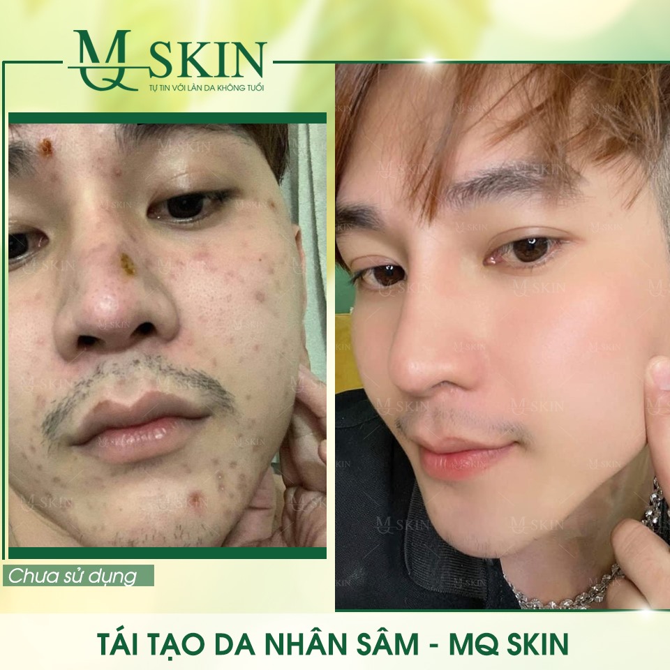 Vì sao "BB Cream tái tạo da MQ Skin" gây siêu bão trên thị trường? Vì sao "BB Cream tái tạo da MQ Skin" gây siêu bão trên thị trường?