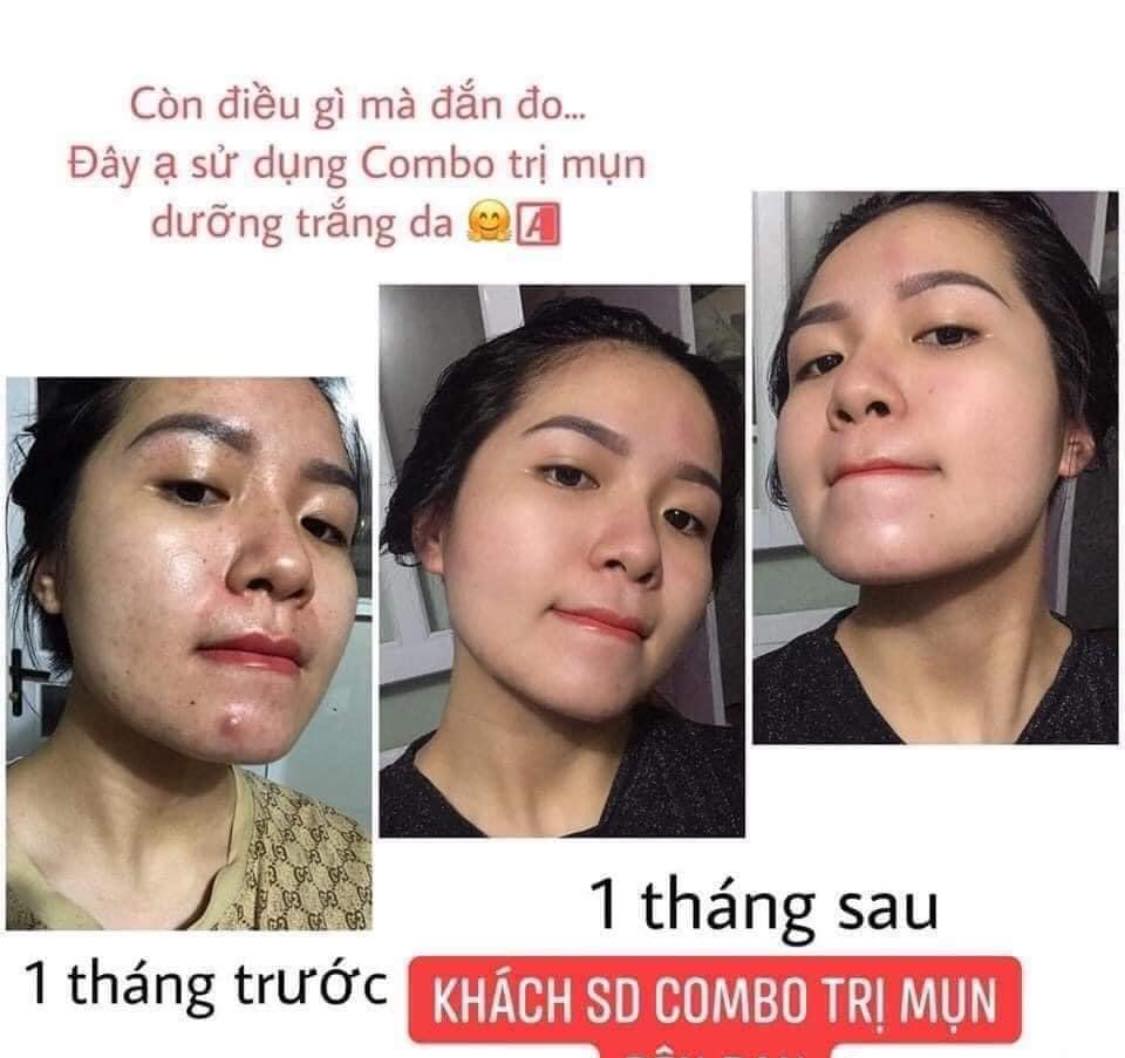 Trị mụn không khó chỉ sợ không chịu khó với A Cosmetics Phương Anh Trị mụn không khó chỉ sợ không chịu khó với A Cosmetics Phương Anh