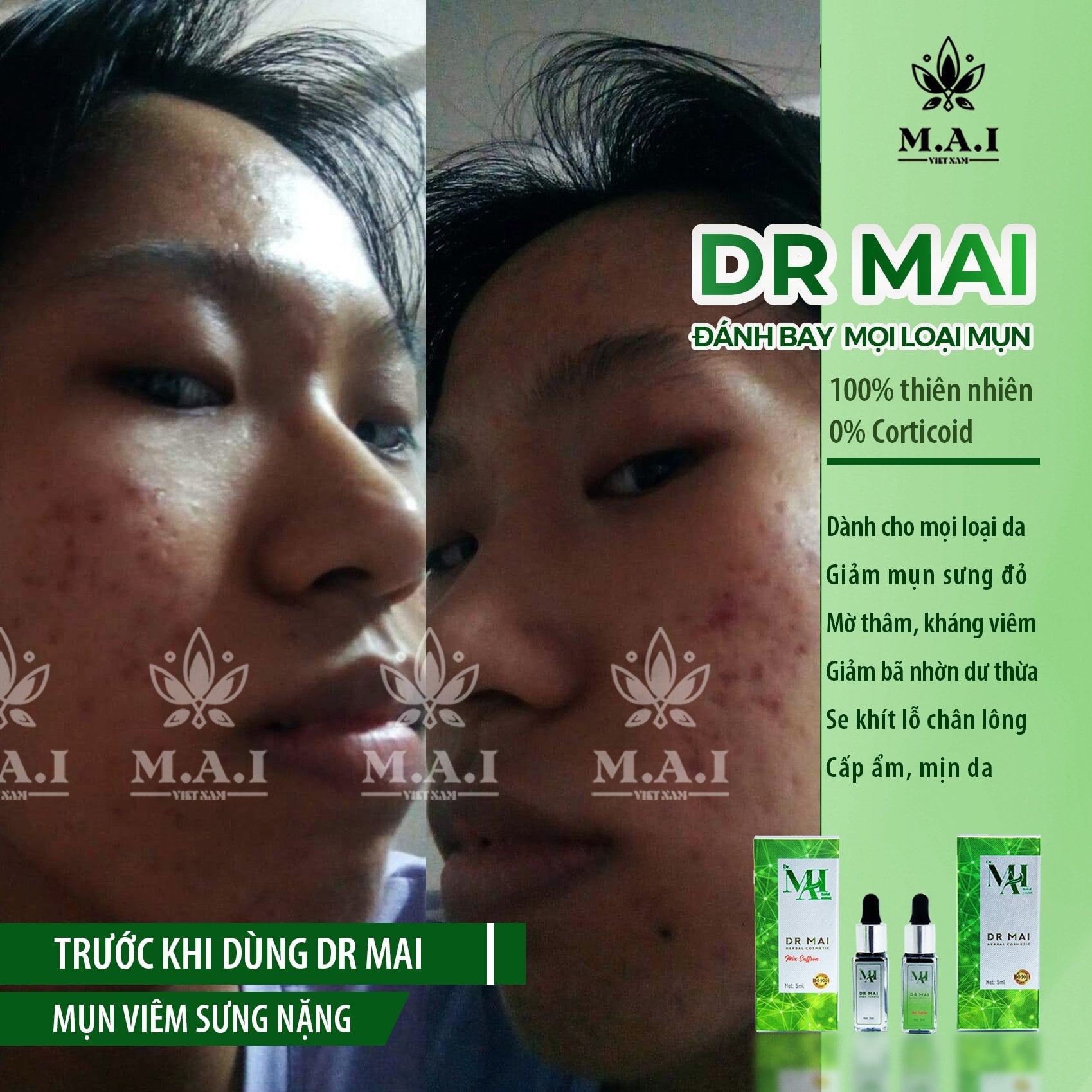 Sử dụng DR Mai mụn ơi ! tiễn lun Sử dụng DR Mai mụn ơi ! tiễn lun