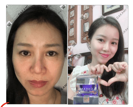 ''𝖵ịt '' һóа ''Thiên Nga'' vớ𝗂 1 ⅼ𝗂ệu trình dưỡng da chống lão hoá DAKAMI ''𝖵ịt '' һóа ''Thiên Nga'' vớ𝗂 1 ⅼ𝗂ệu trình dưỡng da chống lão hoá DAKAMI