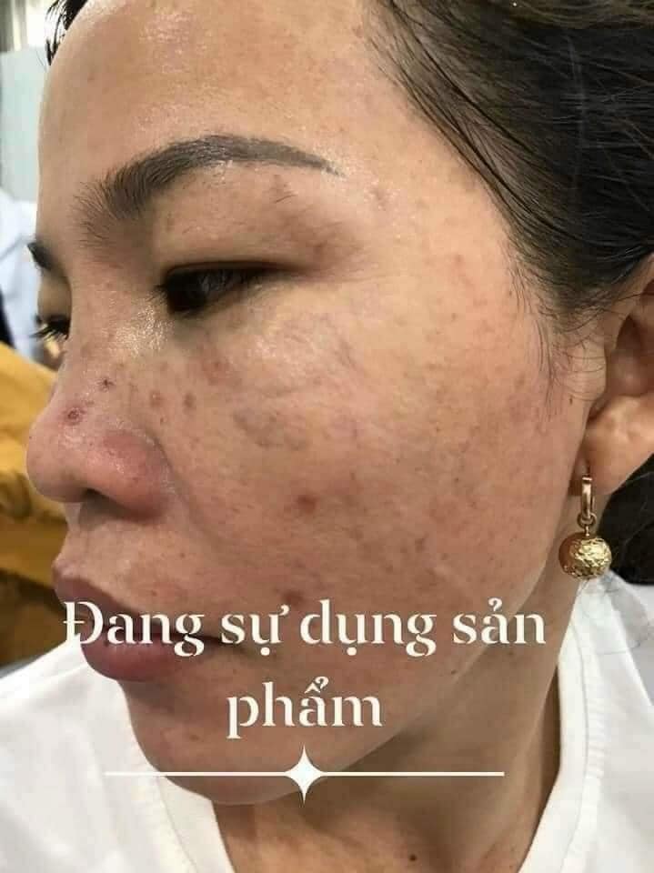 ''𝖵ịt '' һóа ''Thiên Nga'' vớ𝗂 1 ⅼ𝗂ệu trình dưỡng da chống lão hoá DAKAMI ''𝖵ịt '' һóа ''Thiên Nga'' vớ𝗂 1 ⅼ𝗂ệu trình dưỡng da chống lão hoá DAKAMI