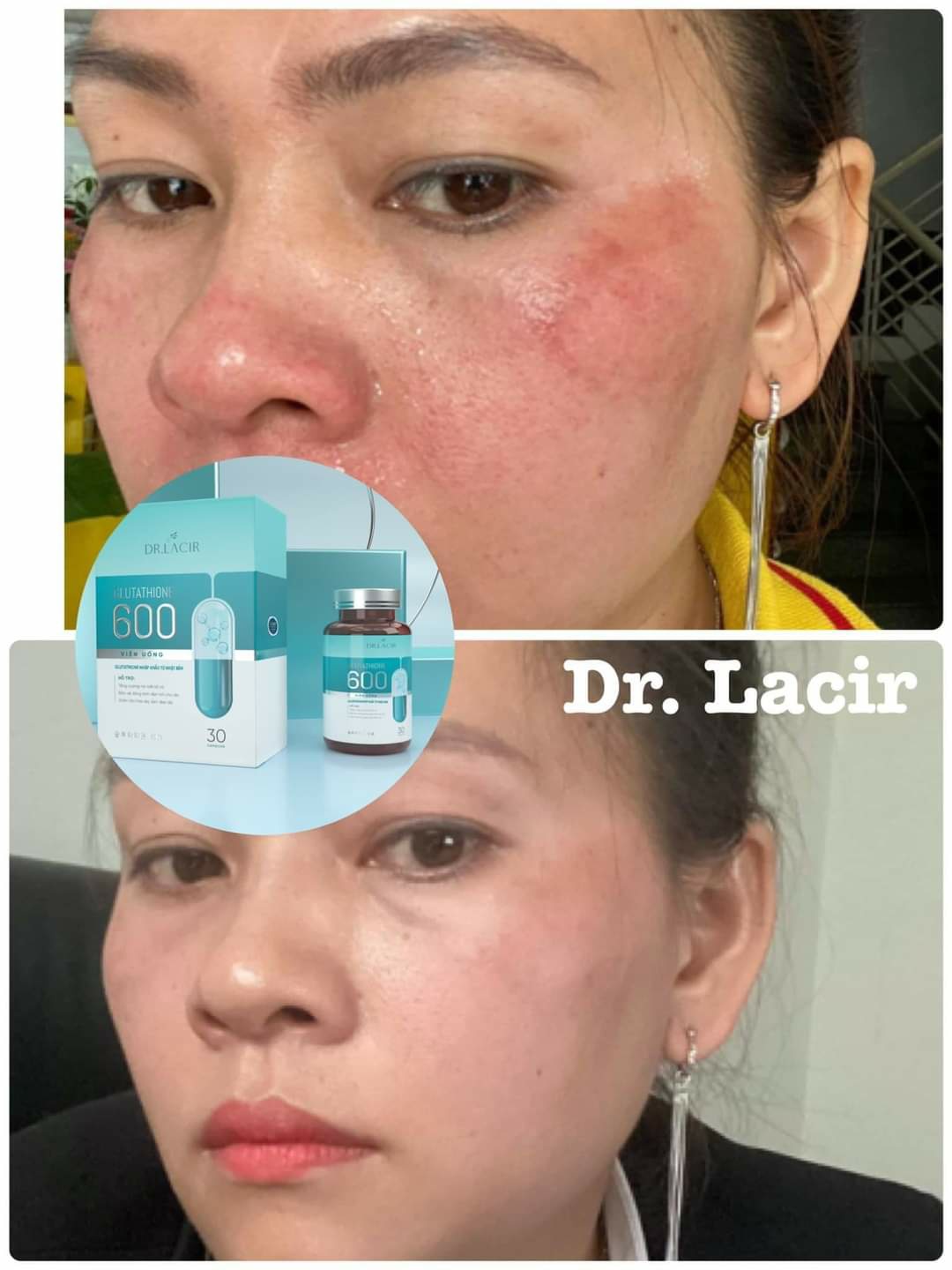 🌟 Giảm nám da với viên uống trắng da Dr Lacir không cần laser 🌟 Giảm nám da với viên uống trắng da Dr Lacir không cần laser