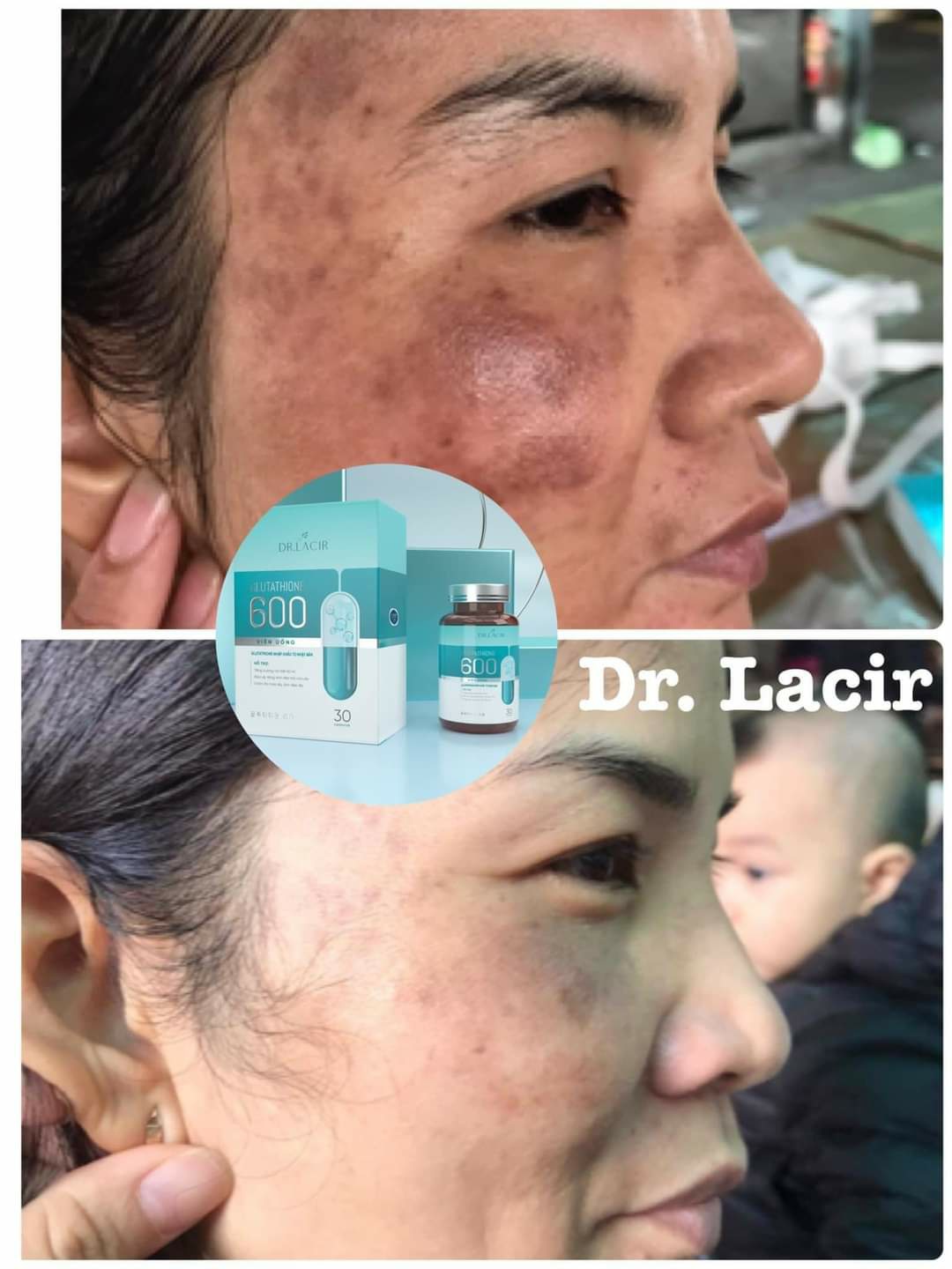 🌟 Giảm nám da với viên uống trắng da Dr Lacir không cần laser