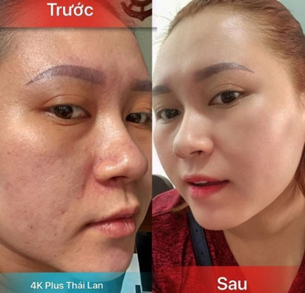 HẾT MỤN SAU 7 NGÀY SỬ DỤNG VỚI KEM THÁI 4K PLUS ĐỎ HẾT MỤN SAU 7 NGÀY SỬ DỤNG VỚI KEM THÁI 4K PLUS ĐỎ