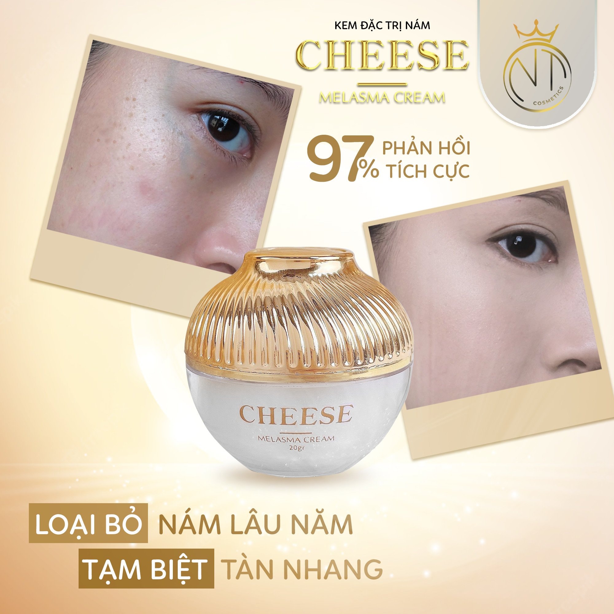 Hết thâm nám - dám tự tin - dám bứt phá khi có Melasma Cream Cheese Hết thâm nám - dám tự tin - dám bứt phá khi có Melasma Cream Cheese