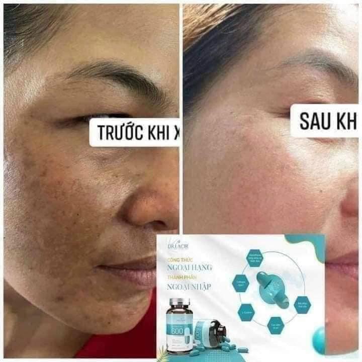 V𝐢𝐞̂𝐧 𝐮𝐨̂́𝐧𝐠 𝐆𝐥𝐮𝐭𝐚𝐭𝐡𝐢𝐨𝐧𝐞 𝐬𝐮̛̉ 𝐝𝐮̣𝐧𝐠 𝐛𝐚𝐨 𝐥𝐚̂𝐮 𝐭𝐡𝐢̀ 𝐜𝐨́ 𝐡𝐢𝐞̣̂𝐮 𝐪𝐮𝐚̉ V𝐢𝐞̂𝐧 𝐮𝐨̂́𝐧𝐠 𝐆𝐥𝐮𝐭𝐚𝐭𝐡𝐢𝐨𝐧𝐞 𝐬𝐮̛̉ 𝐝𝐮̣𝐧𝐠 𝐛𝐚𝐨 𝐥𝐚̂𝐮 𝐭𝐡𝐢̀ 𝐜𝐨́ 𝐡𝐢𝐞̣̂𝐮 𝐪𝐮𝐚̉