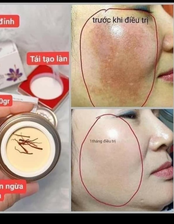 Kem Face Trị Nám Dưỡng Trắng Da Saffron Napoli Hải Âu Việt Kem Face Trị Nám Dưỡng Trắng Da Saffron Napoli Hải Âu Việt