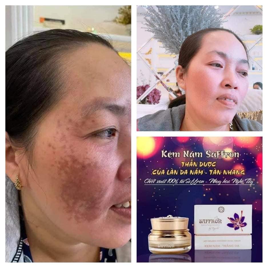 Kem Face Trị Nám Dưỡng Trắng Da Saffron Napoli Hải Âu Việt Kem Face Trị Nám Dưỡng Trắng Da Saffron Napoli Hải Âu Việt