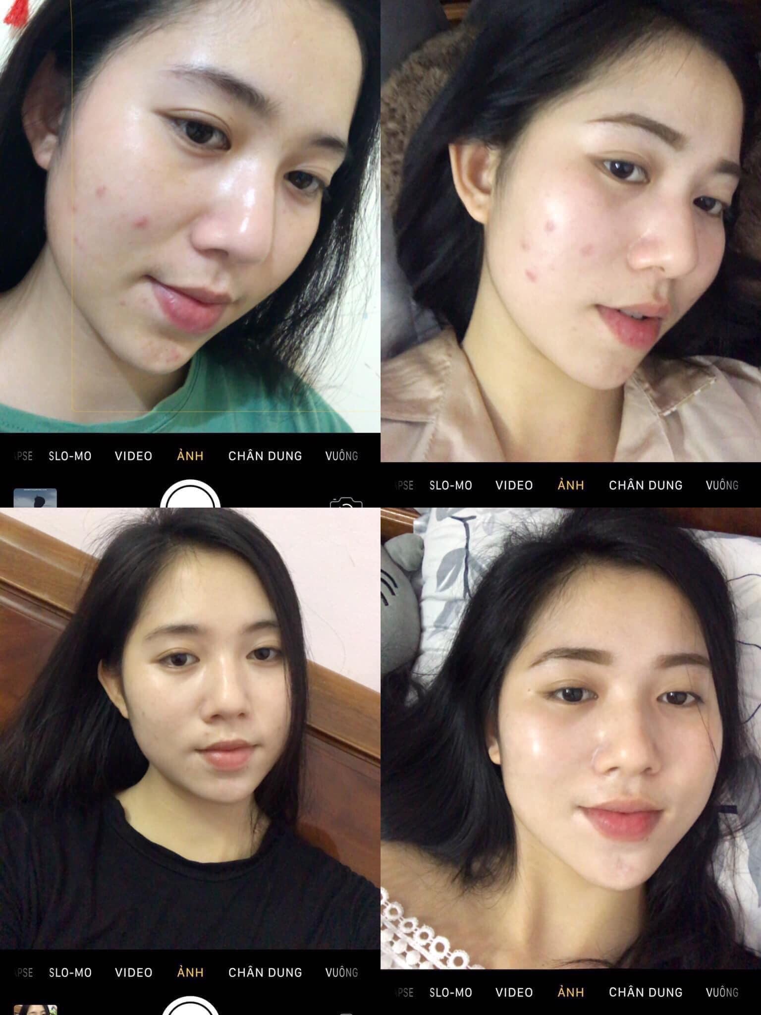 Không thử thuốc này sẽ không bao giờ biết khi nào da mặt mới được sạch mụn