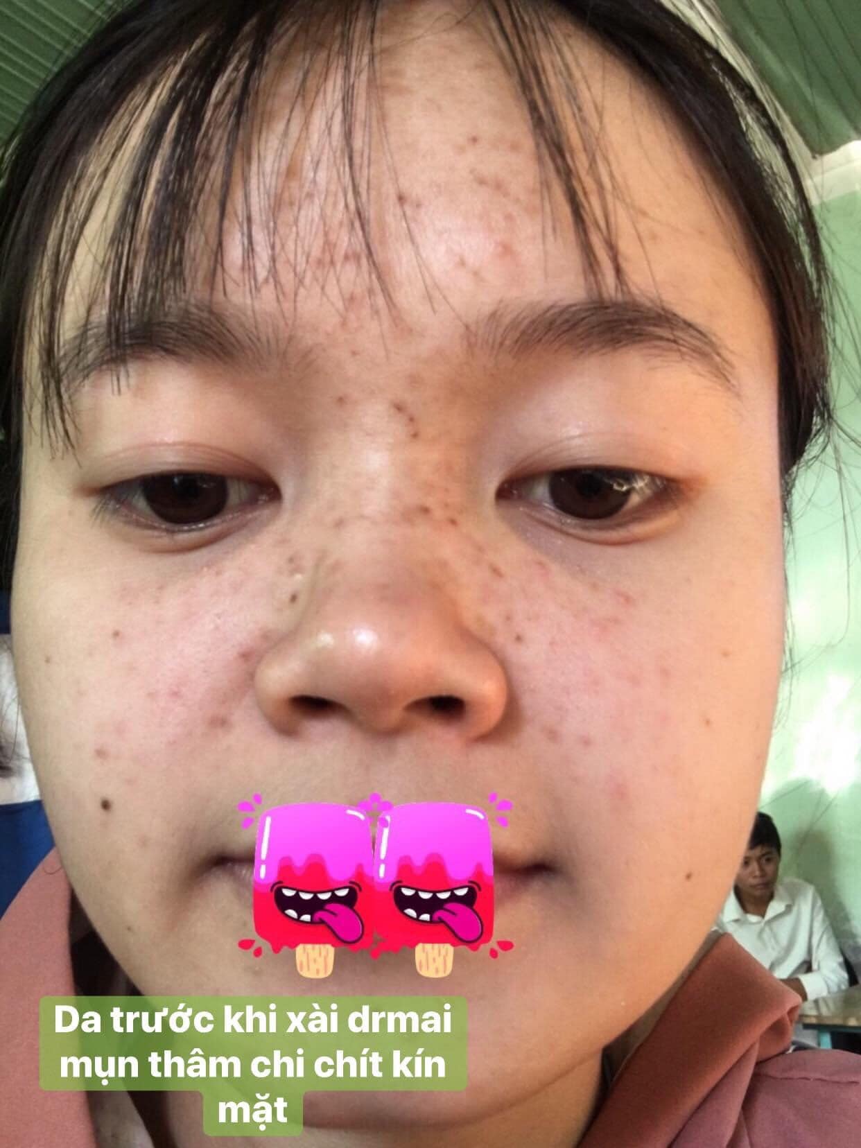 Phụ nữ muốn đẹp phải siêng, đừng lười biếng để mặt đầy mụn