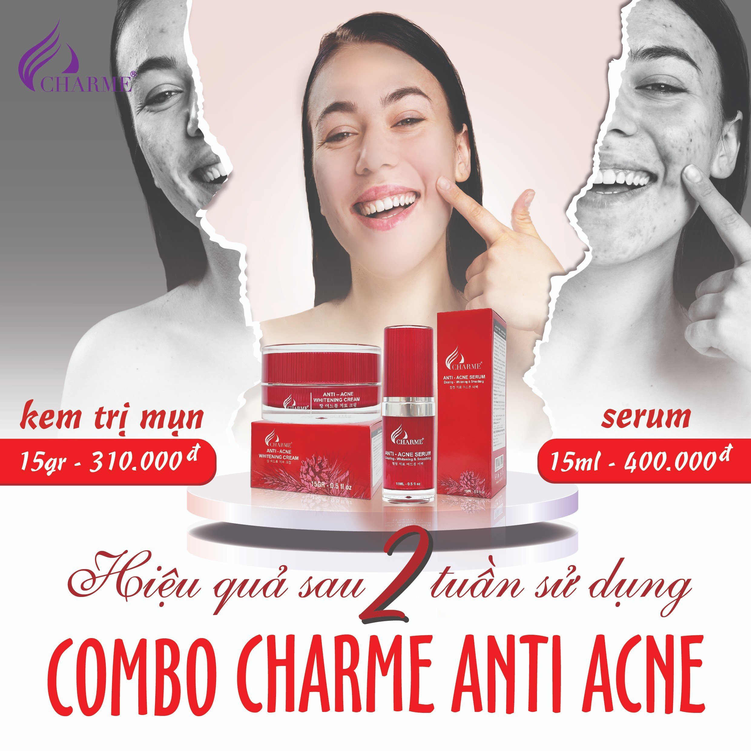 Cùng Charme chia sẻ bí quyết trị mụn với combo trị mụn Thông Đỏ