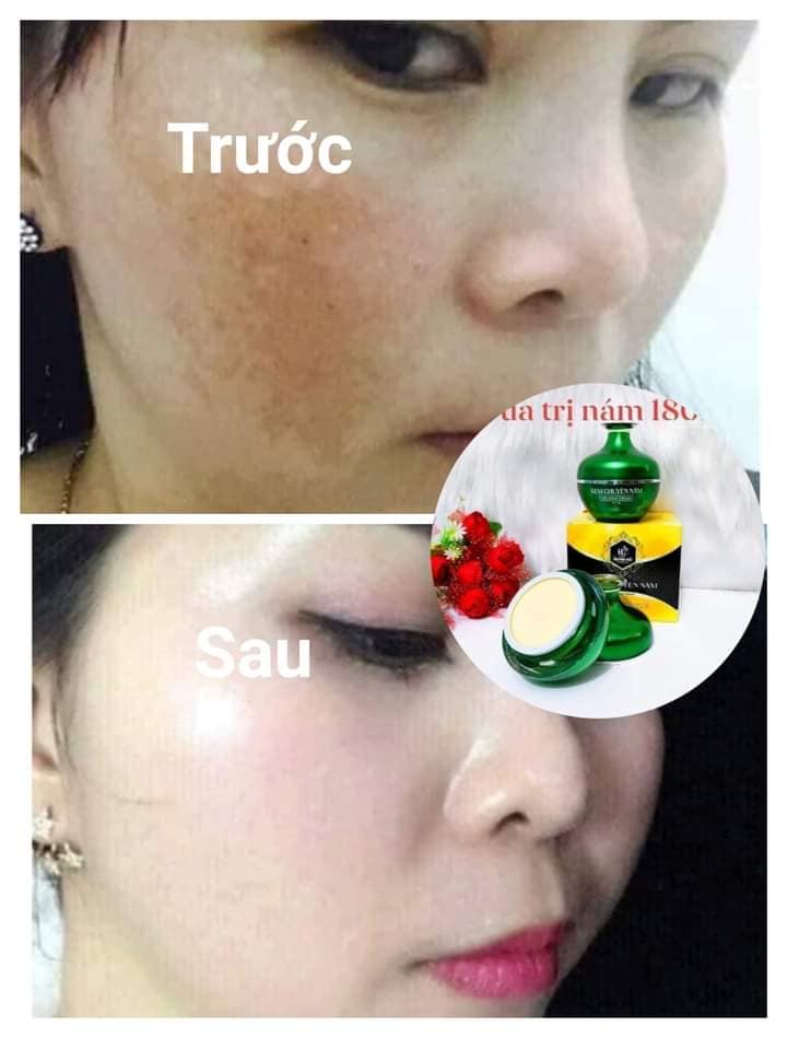 Nám nó rất lì nên người trị phải kiên trì