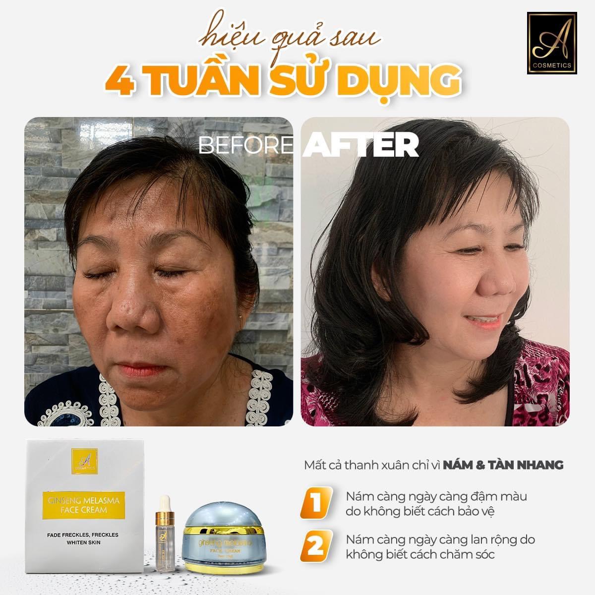 Thanh Xuân chỉ có một lần Cớ sao không đẹp để bằng người ta Face nám Nhân Sâm