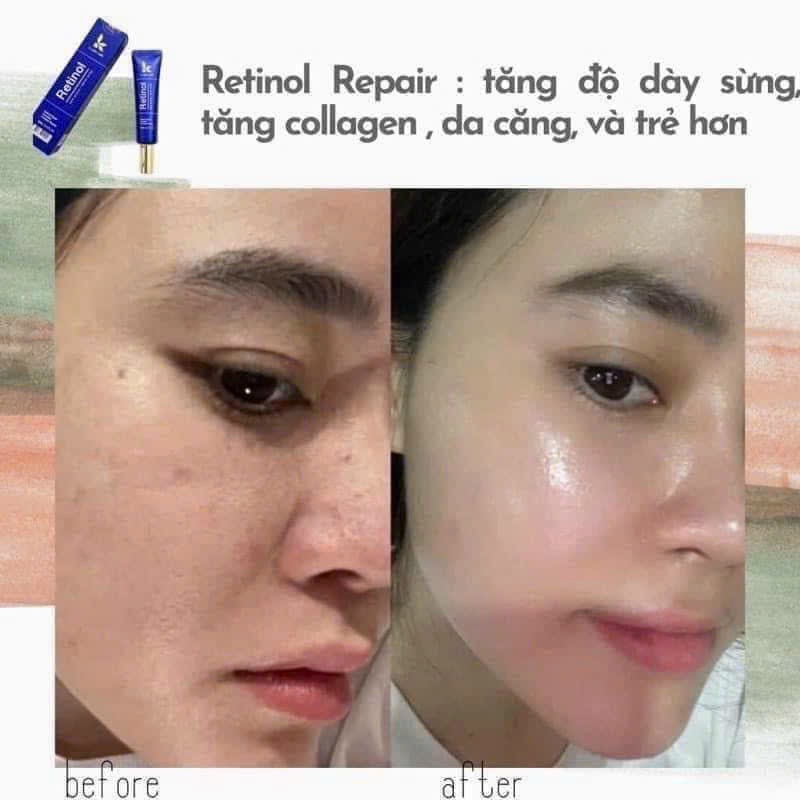 Giờ mà chưa biết Retinol K lady Care thì đúng là hối tiếc suốt đời luôn á Giờ mà chưa biết Retinol K lady Care thì đúng là hối tiếc suốt đời luôn á