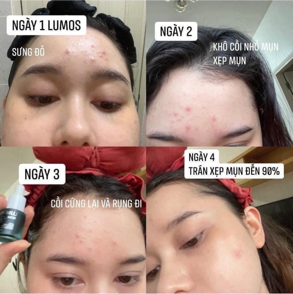 Serum trị mụn lumos phải gọi là đỉnh của đỉnh về trị mụn lun đó ạ Serum trị mụn lumos phải gọi là đỉnh của đỉnh về trị mụn lun đó ạ