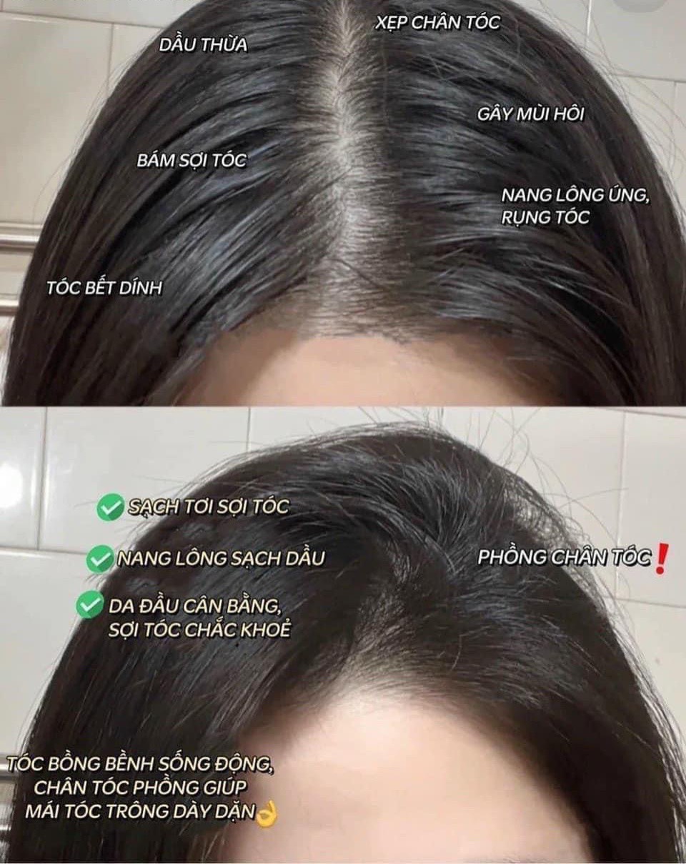 Vừa muốn giảm rụng kích mọc tóc mà lại muốn phục hồi luôn thì dùng Combo này đi chị em Vừa muốn giảm rụng kích mọc tóc mà lại muốn phục hồi luôn thì dùng Combo này đi chị em