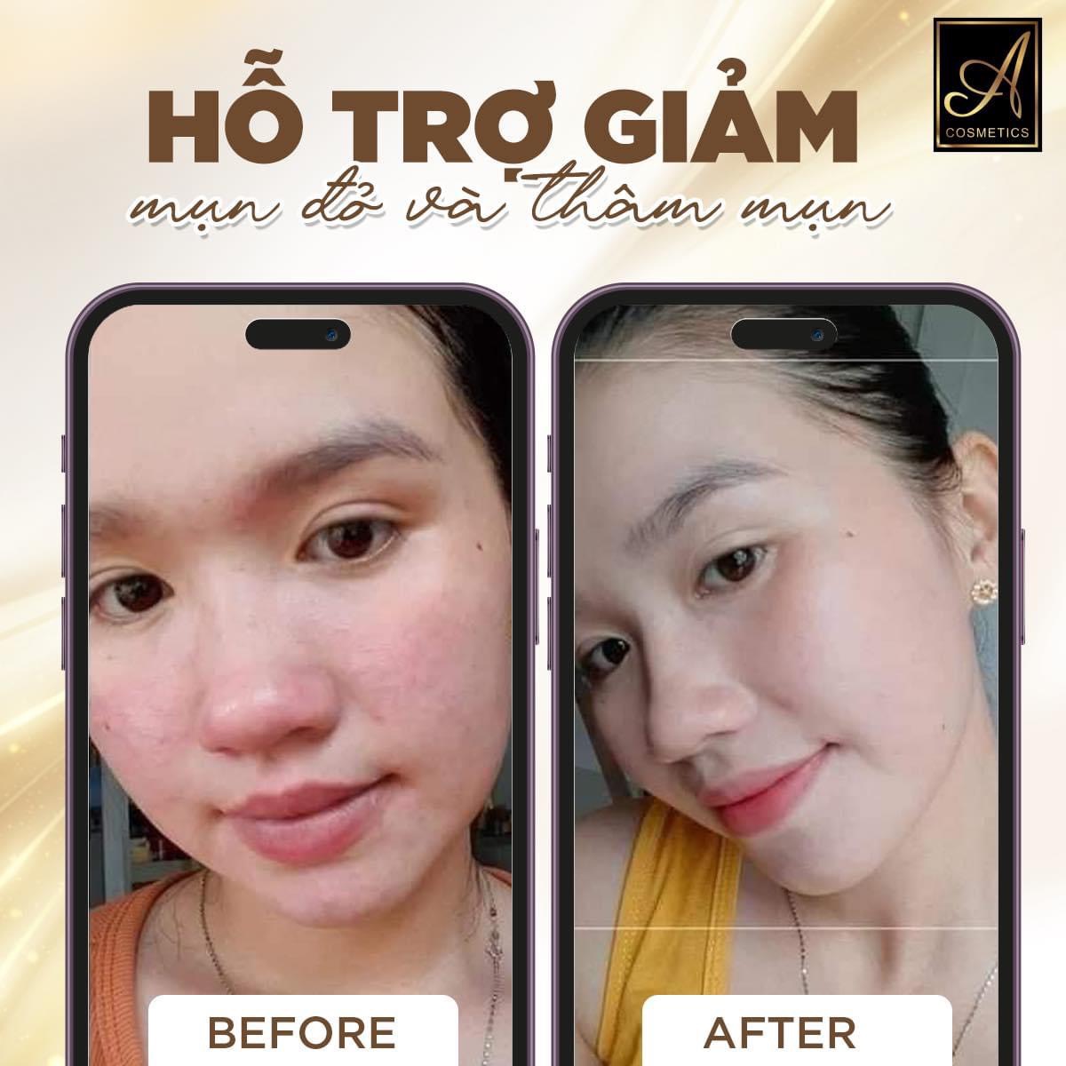 combo trị mụn Beauty One Day combo trị mụn Beauty One Day