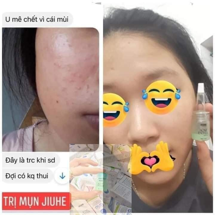 Tại sao tôi khuyên bạn nên dùng Jiuhe Acne Extra để trị mụn Tại sao tôi khuyên bạn nên dùng Jiuhe Acne Extra để trị mụn