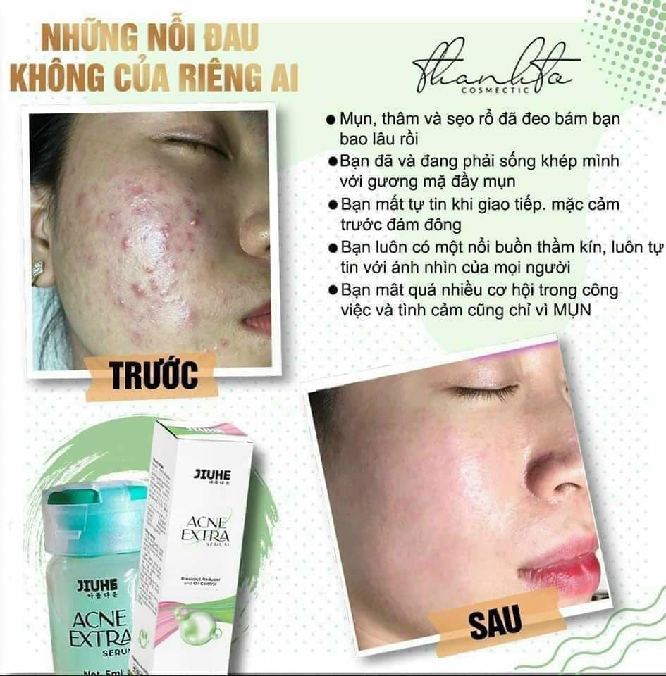 Sạch mụn liền tay có ngay Jiuhe Acne Extra Sạch mụn liền tay có ngay Jiuhe Acne Extra