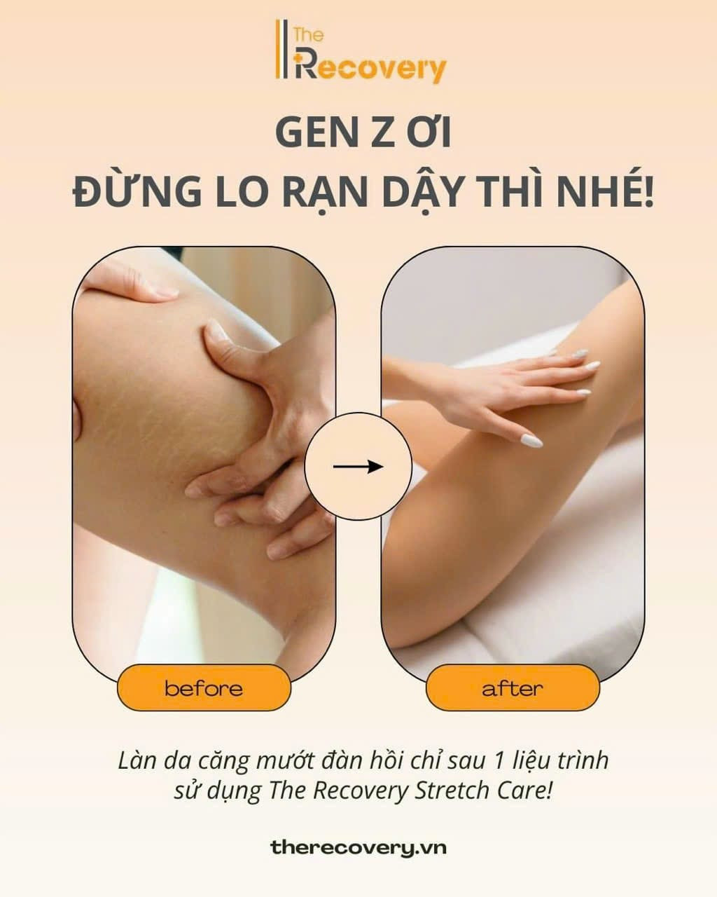 Đừng để rạn da do tăng cân làm bạn mất tự tin Đừng để rạn da do tăng cân làm bạn mất tự tin