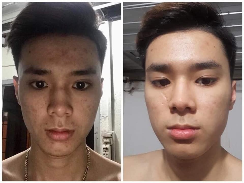 DR MAI trị mụn cho nam