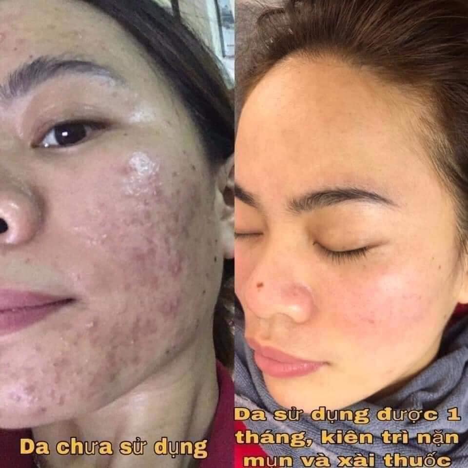 Tác dụng của việc lấy nhân mụn