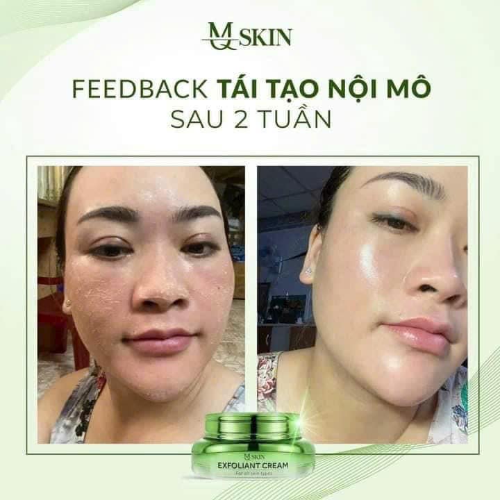 Kem Face Tái Tạo Nội Sinh Exfoliant Cream MQ Skin Tặng Kem Dưỡng HA Kem Face Tái Tạo Nội Sinh Exfoliant Cream MQ Skin Tặng Kem Dưỡng HA