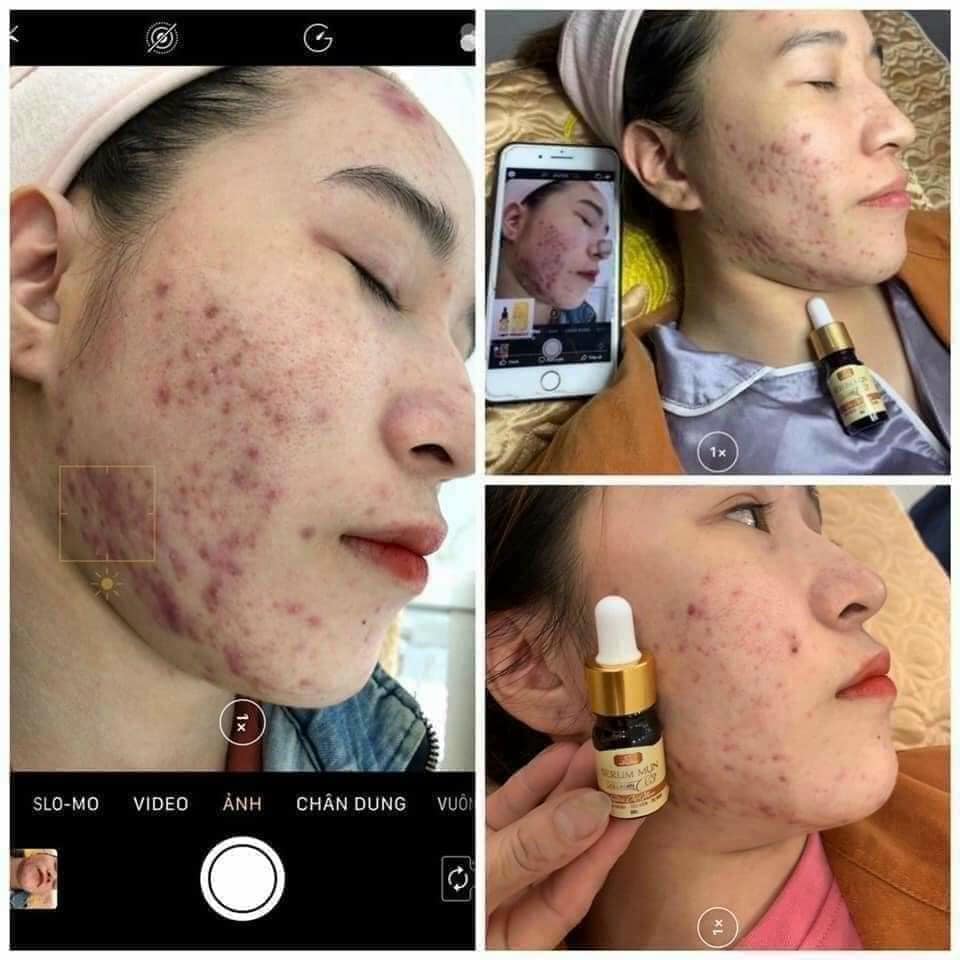 serum trị mụn x3 với tinh chất chiếc xuất từ thiên nhiên serum trị mụn x3 với tinh chất chiếc xuất từ thiên nhiên