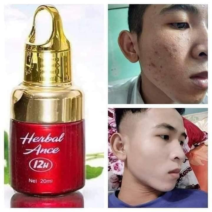 Serum Trị mụn Herbal Ance 12H mang lại 1 nhiệm vụ riêng là chuyên trị mụn và phục hồi ở tầng sau dưới da Serum Trị mụn Herbal Ance 12H mang lại 1 nhiệm vụ riêng là chuyên trị mụn và phục hồi ở tầng sau dưới da
