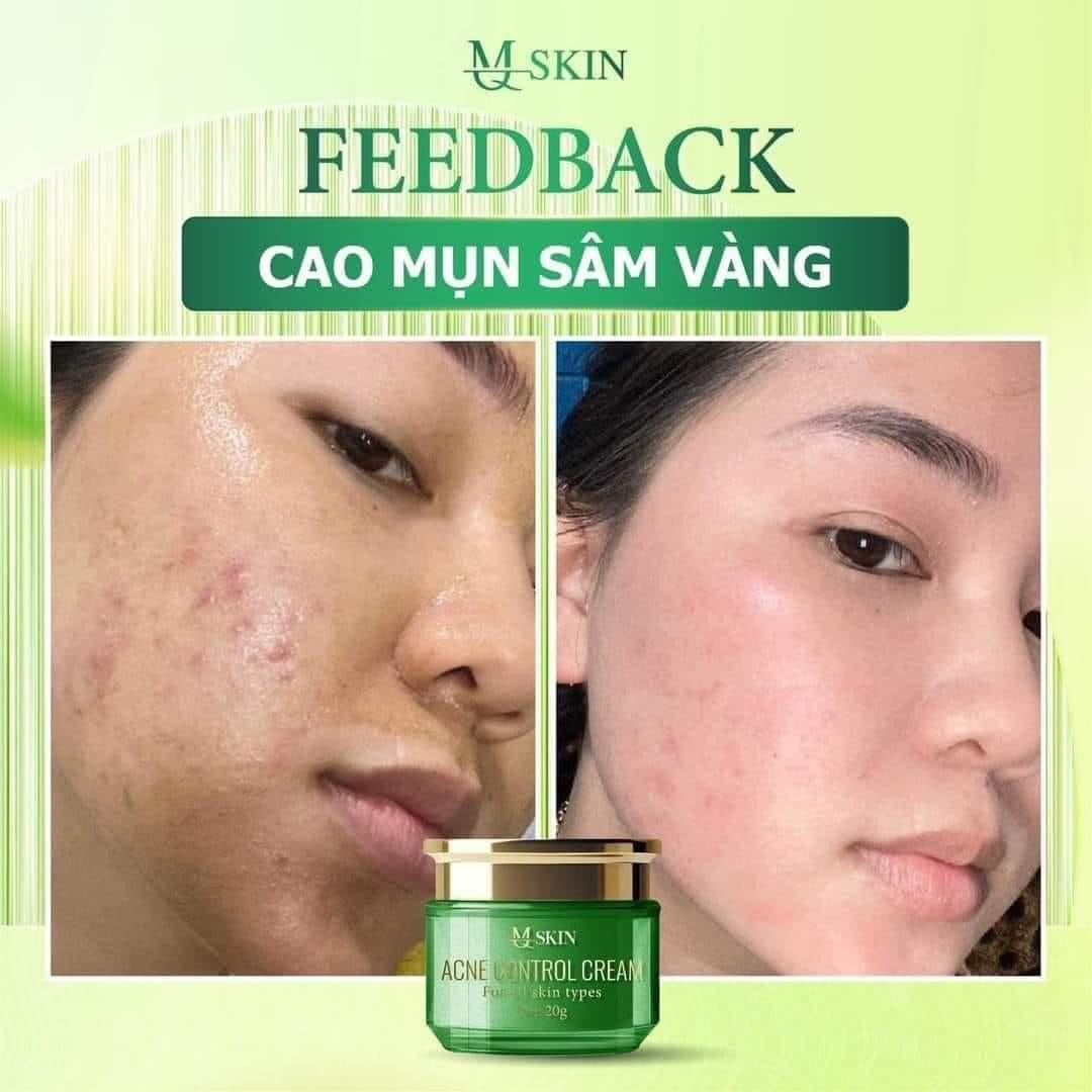 Cao Mụn Sâm Vàng MQ Skin hiệu quả trong việc chăm sóc da Cao Mụn Sâm Vàng MQ Skin hiệu quả trong việc chăm sóc da